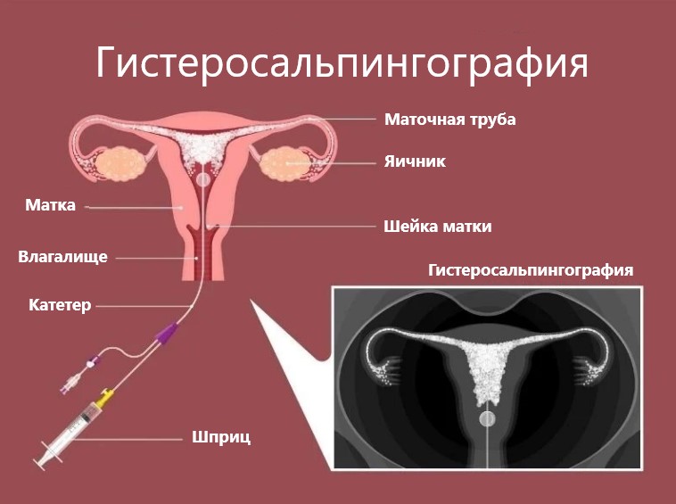 Гистеросальпингография